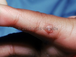 Traumatic neuroma