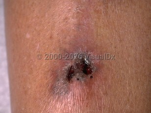 Mucormycosis