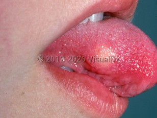 Granular cell tumor