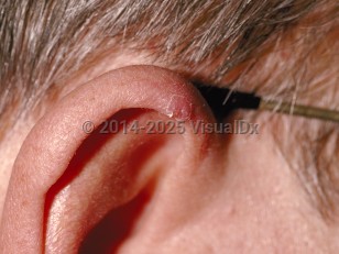 Chondrodermatitis nodularis helicis