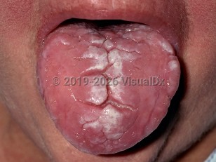 Clinical image of Fissured tongue - imageId=247783. Click to open in gallery.  caption: 'A deep central furrow with smaller, shallower furrows branching off it on the central tongue. Note also the white plaques (superimposed candidiasis).&nbsp;'