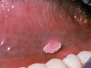 Oral papilloma