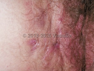Crohn disease