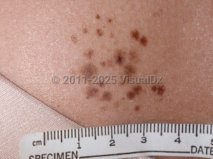 Agminated nevus