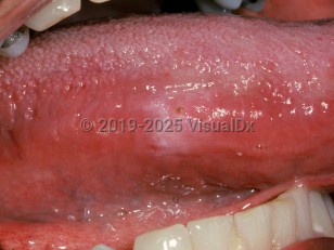 Oral frictional hyperkeratosis