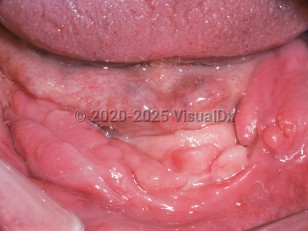 Denture-induced hyperplasia