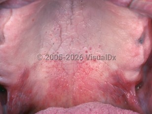 Nicotine stomatitis