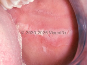 Contact stomatitis