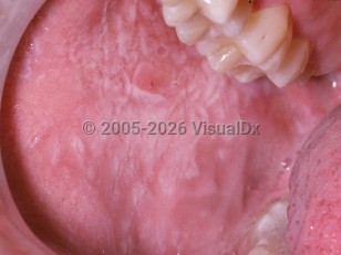 white-sponge-nevus-oral-infection-by-staphylococcus-aureus-in-patients