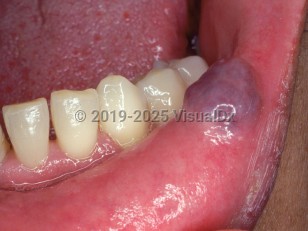 Oral varices