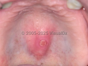 Traumatic oral ulcer