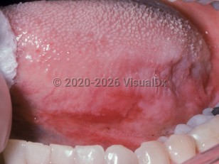 Oral erythroplakia
