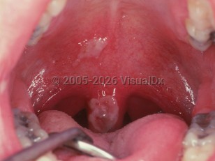 Clinical image of Burns of oral mucosa - imageId=2504639. Click to open in gallery.  caption: 'Whitish, slightly opalescent plaques on the palate and uvula.'