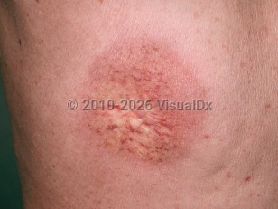 Clinical image of Radiation dermatitis - imageId=250723. Click to open in gallery.  caption: 'A close-up of a circular, thin, wrinkled, erythematous plaque with telangiectasias and scarring, following therapeutic radiation.'