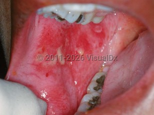Clinical image of Chemotherapy-induced mucositis - imageId=2512895. Click to open in gallery.  caption: 'Extensive chemotherapy-induced, slough-covered erosions on the buccal mucosa.'