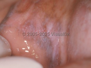 Oral lichen planus