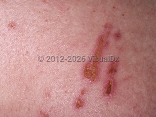 Neurotic excoriations