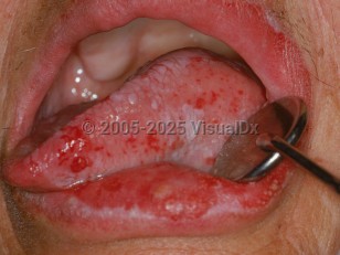 Proliferative verrucous leukoplakia