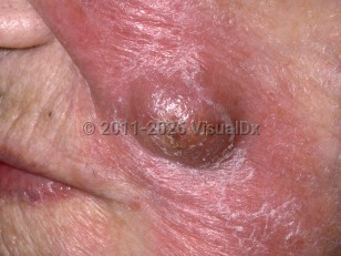 Actinomycosis