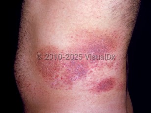 Clinical image of Poikiloderma vasculare atrophicans - imageId=2528576. Click to open in gallery.  caption: 'A broad poikilodermatous plaque with white atrophic  and violaceous scaly portions on the flank.'