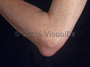 Bursitis