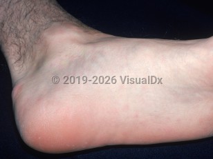 Streptobacillus moniliformis rat-bite fever