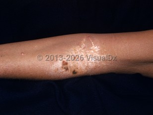 Biliary hypercholesterolemic xanthomatosis