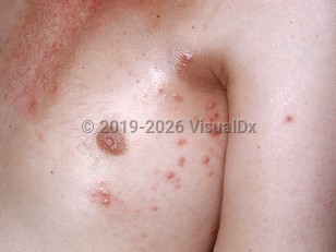 Hodgkin lymphoma