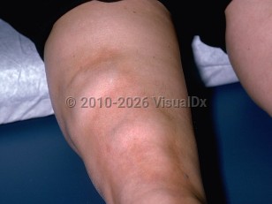 Clinical image of Eosinophilic fasciitis - imageId=253795. Click to open in gallery.  caption: 'Skin-colored nodules with a surrounding bound-down appearance of the thigh.'