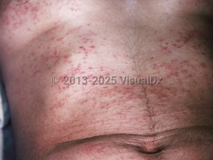Clinical image of Seabather's eruption - imageId=253952. Click to open in gallery.  caption: 'Myriads of erythematous papules on the trunk (areas that were beneath a bathing suit).'