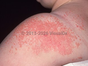 Clinical image of Xanthoma disseminatum - imageId=2546740. Click to open in gallery.  caption: 'Multiple thin orange-red papules, coalescing to form plaques on the shoulder, arm, and upper back.'