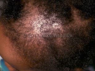 Drug-induced alopecia