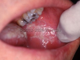 Chronic cheek chewing