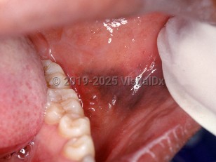 Multifocal or diffuse mucosal pigmentation