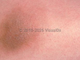 Vitamin K injection site reaction