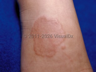 Clinical image of Granuloma annulare - imageId=25856. Click to open in gallery.  caption: 'Annular, orange-red, smooth plaque on the dorsal hand.'