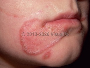 Tinea faciei