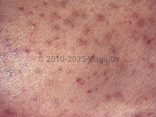 Pityrosporum folliculitis