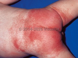 Diaper irritant contact dermatitis