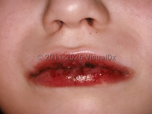hepatitis c on lips virus infection and oral lichen planus: A controversial association Hepatitis C Rash: Symptoms, Pictures,