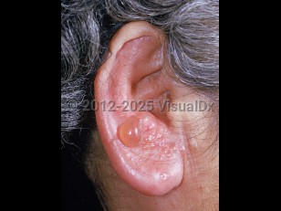 Ramsay-Hunt syndrome