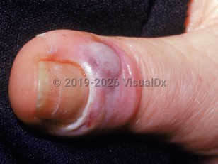 melanotic whitlow causes Mole on toe, close-up | Stock Image Herpetic Whitlow Symptoms, Causes and