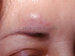 Foreign body granuloma