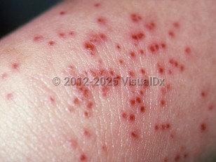 Eczema herpeticum