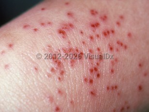 Eczema herpeticum