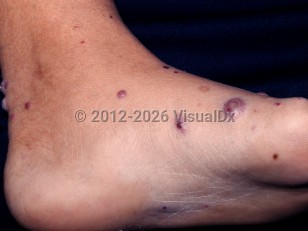 Clinical image of Perforating folliculitis - imageId=2703842. Click to open in gallery. 