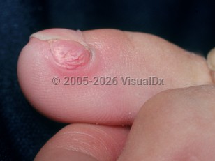 Subungual exostosis
