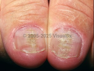 Clinical image of Onychotillomania - imageId=2704562. Click to open in gallery.  caption: 'A central longitudinal groove with a few parallel transverse grooves and overlying hyperkeratosis on each thumbnail. Note also the enlarged lunulae.'