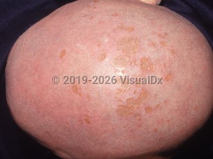 Delusions of parasitosis