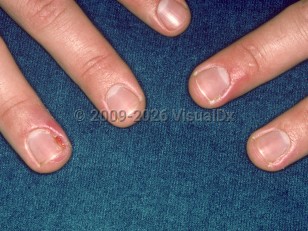 Clinical image of Drug-induced paronychia - imageId=2717438. Click to open in gallery. 